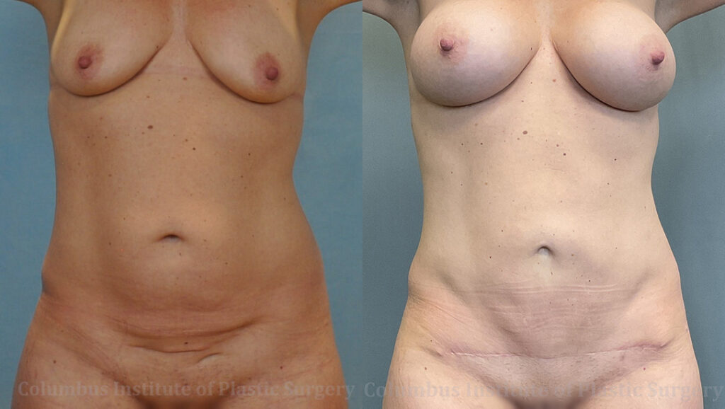 Mommy Makeover before and after photo by Columbus Institute of Plastic Surgery in Columbus, OH
