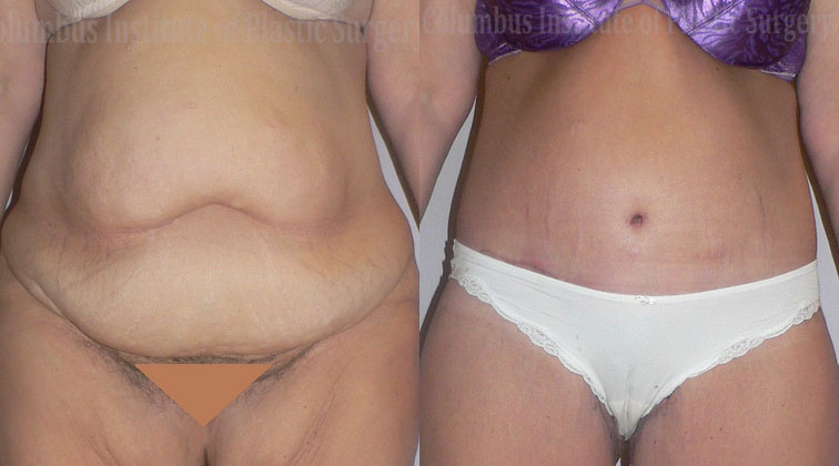 Belt Lipectomy before and after photo by Columbus Institute of Plastic Surgery in Columbus, OH