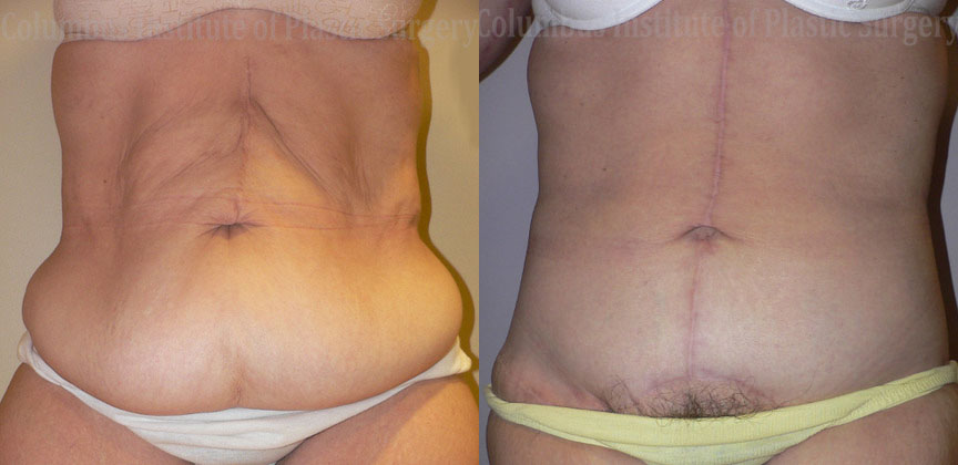 Belt Lipectomy before and after photo by Columbus Institute of Plastic Surgery in Columbus, OH
