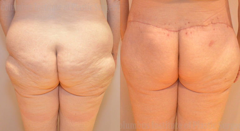 Buttock Lift before and after photo by Columbus Institute of Plastic Surgery in Columbus, OH
