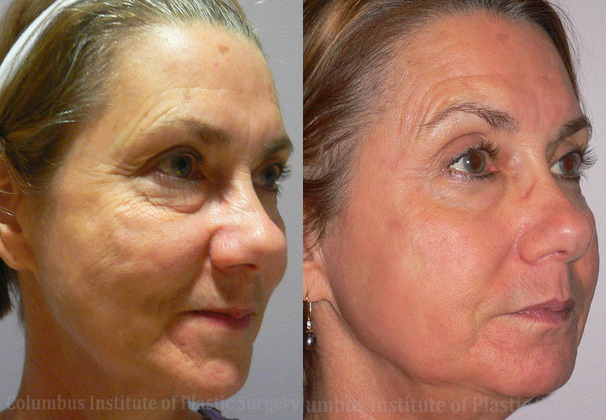 Laser Skin Resurfacing before and after photo by Columbus Institute of Plastic Surgery in Columbus, OH